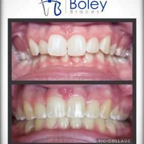 Bild von Boley Braces