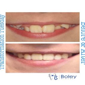 Bild von Boley Braces