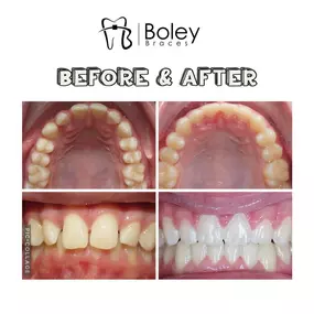 Bild von Boley Braces