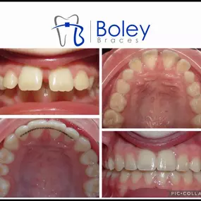 Bild von Boley Braces