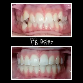 Bild von Boley Braces