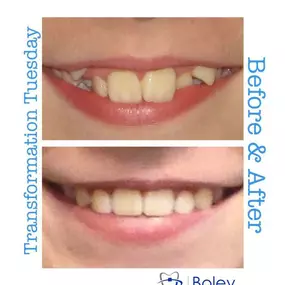 Bild von Boley Braces