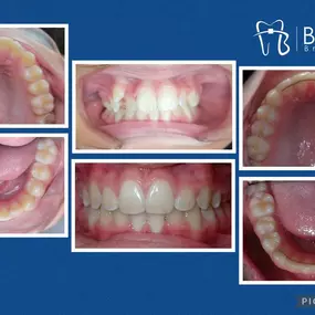 Bild von Boley Braces