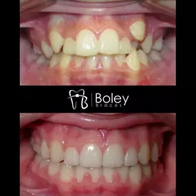 Bild von Boley Braces