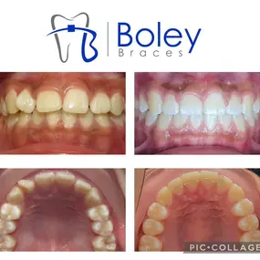 Bild von Boley Braces