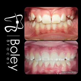 Bild von Boley Braces