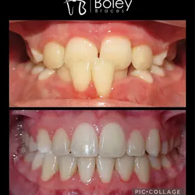 Bild von Boley Braces