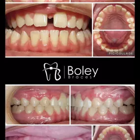 Bild von Boley Braces