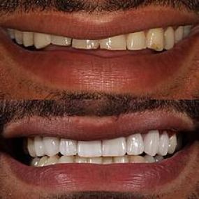 8 upper porcelain veneers to restore worn down teeth