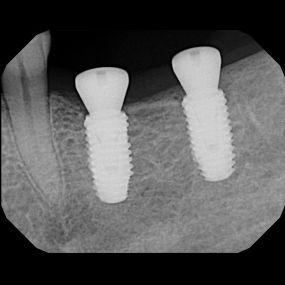 Patients X-Ray reports for Dental Implants