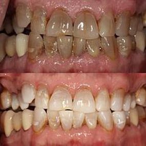 Severe Tetracycline staining treated with KOR whitening