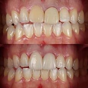 Before and After Image of a dental treatment