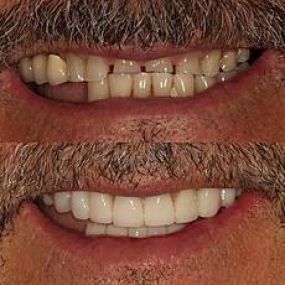 Full Mouth Reconstruction using porcelain crowns