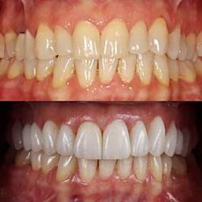 Before and After Image of a dental treatment