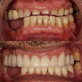 Full Mouth Reconstruction using porcelain crowns