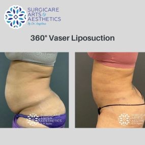 360-Degree Liposuction Before & After Photos