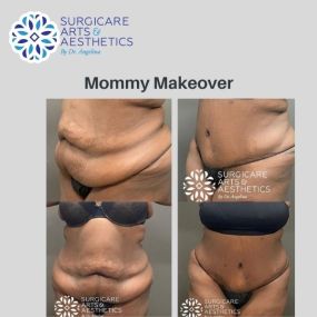 Mommy Makeover Before & After Photos