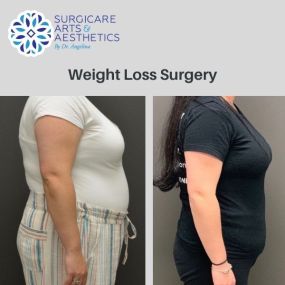 Weight Loss Surgery Before & After Photos