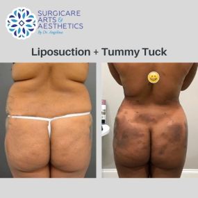Tummy Tuck and Liposuction Before & After Photos