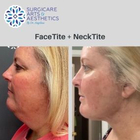 FaceTite™ and NeckTite™ Before & After Photos