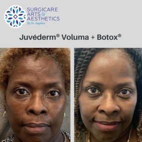 Juvéderm® Voluma and Botox® Before & After Photos