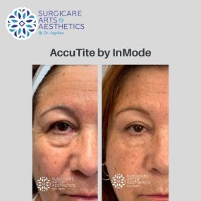AccuTite™ Before & After Photos