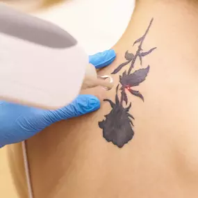 Tattoo Removal