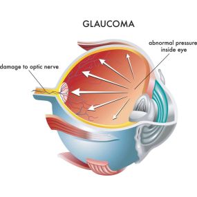 glaucoma eye diagram