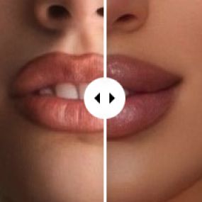 Cosmetic Lip Filler