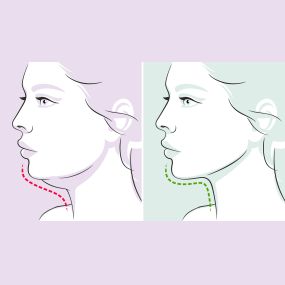 Get Rid of Your Turkey Neck
