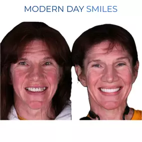 Smile makeover showcasing improved alignment and brightness