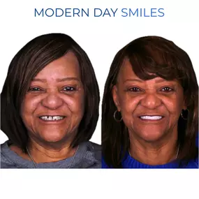 Renewed smile after full-mouth rehabilitation