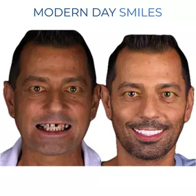 Smile rejuvenation through modern dental techniques
