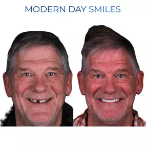 Comprehensive smile upgrade for better symmetry