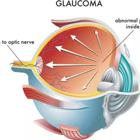 glaucoma eye diagram