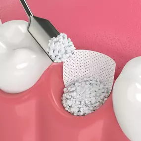 At Maniscalco Oral Surgery and Implant Center, we are highly skilled at choosing the precise bone graft materials and placement to restore the quality and quantity of your jawbone. With our advanced materials and precision surgery, we're Birmingham's choice for the most successful and least stressful dental bone grafting procedures.