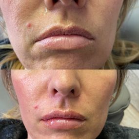 Injectables Longmont