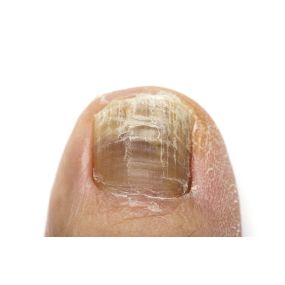 A big toe with telltale characteristics of toenail fungus