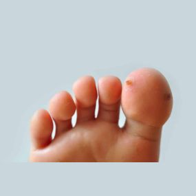 Wart verruca on feet dermatology