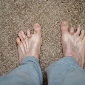 man with hammertoes