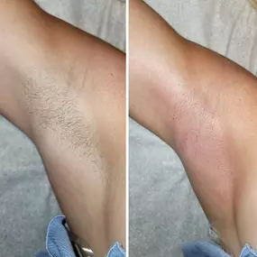 Underarm Wax Before and After