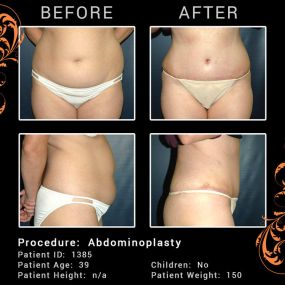 Abdominoplasty, also known as a tummy tuck, is designed to firm and smooth the abdomen. 

This cosmetic procedure removes excess skin and fat from the abdomen and may also tighten the muscles of the abdominal wall. Women and men alike benefit from an abdominoplasty procedure. Typically the ideal candidate is in relatively good shape, but have loose abdominal skin and/or a significant amount of abdominal fat that won’t respond to dieting or exercise. The results of this procedure provide a smooth