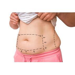 Tummy Tuck Surgery in Scottsdale AZ