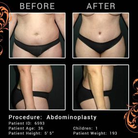 You may be a good candidate for a Tummy Tuck (Abdominoplasty) if you have one or more of the following conditions:

Excess or loose abdominal skin, often the result of massive weight loss
An abdomen that protrudes and is out of proportion to the rest of the body
Abdominal muscles that have been weakened by pregnancy or aging
Excess fat that is concentrated beneath the abdominal skin
Those exploring abdominoplasty that have plans to become pregnant or lose a significant amount of weight should di