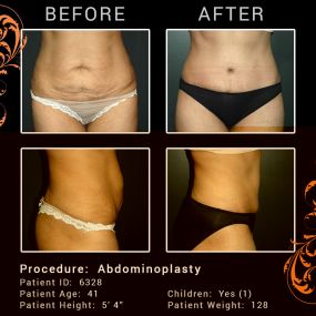 Abdominoplasty, also known as a tummy tuck, is designed to firm and smooth the abdomen. 

This cosmetic procedure removes excess skin and fat from the abdomen and may also tighten the muscles of the abdominal wall. Women and men alike benefit from an abdominoplasty procedure. Typically the ideal candidate is in relatively good shape, but have loose abdominal skin and/or a significant amount of abdominal fat that won’t respond to dieting or exercise. The results of this procedure provide a smooth