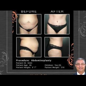 Tummy Tuck in Scottsdale