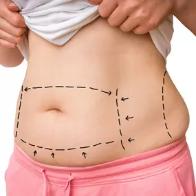 Tummy Tuck Surgery in Scottsdale AZ