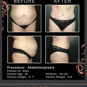 Tummy Tuck in Scottsdale