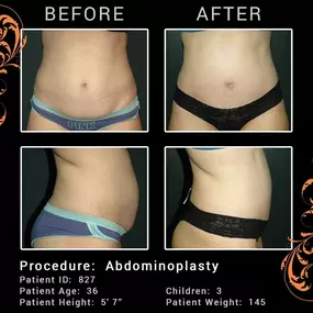 Tummy tuck before after pics - Abdominoplasty, also known as a tummy tuck, is designed to firm and smooth the abdomen. 

This cosmetic procedure removes excess skin and fat from the abdomen and may also tighten the muscles of the abdominal wall. Women and men alike benefit from an abdominoplasty procedure. Typically the ideal candidate is in relatively good shape, but have loose abdominal skin and/or a significant amount of abdominal fat that won’t respond to dieting or exercise. The results of 