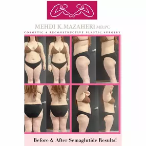 before and after semaglutide injections
